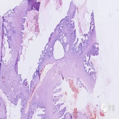 高龄卵巢黏液性肿瘤（李斌分享，刘从容老师讲解）