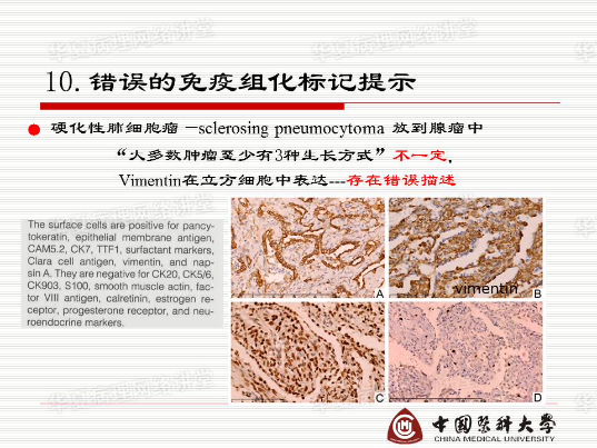 结合实际病例学习《硬化性肺细胞瘤的诊断陷阱》