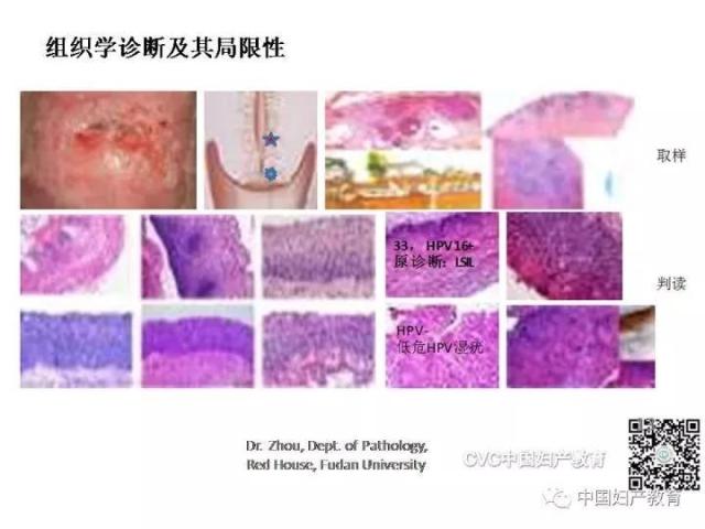 独家专访国内妇产科病理大咖周先荣教授：子宫颈上皮内病变及相关临床情况的若干病理学问题（一）