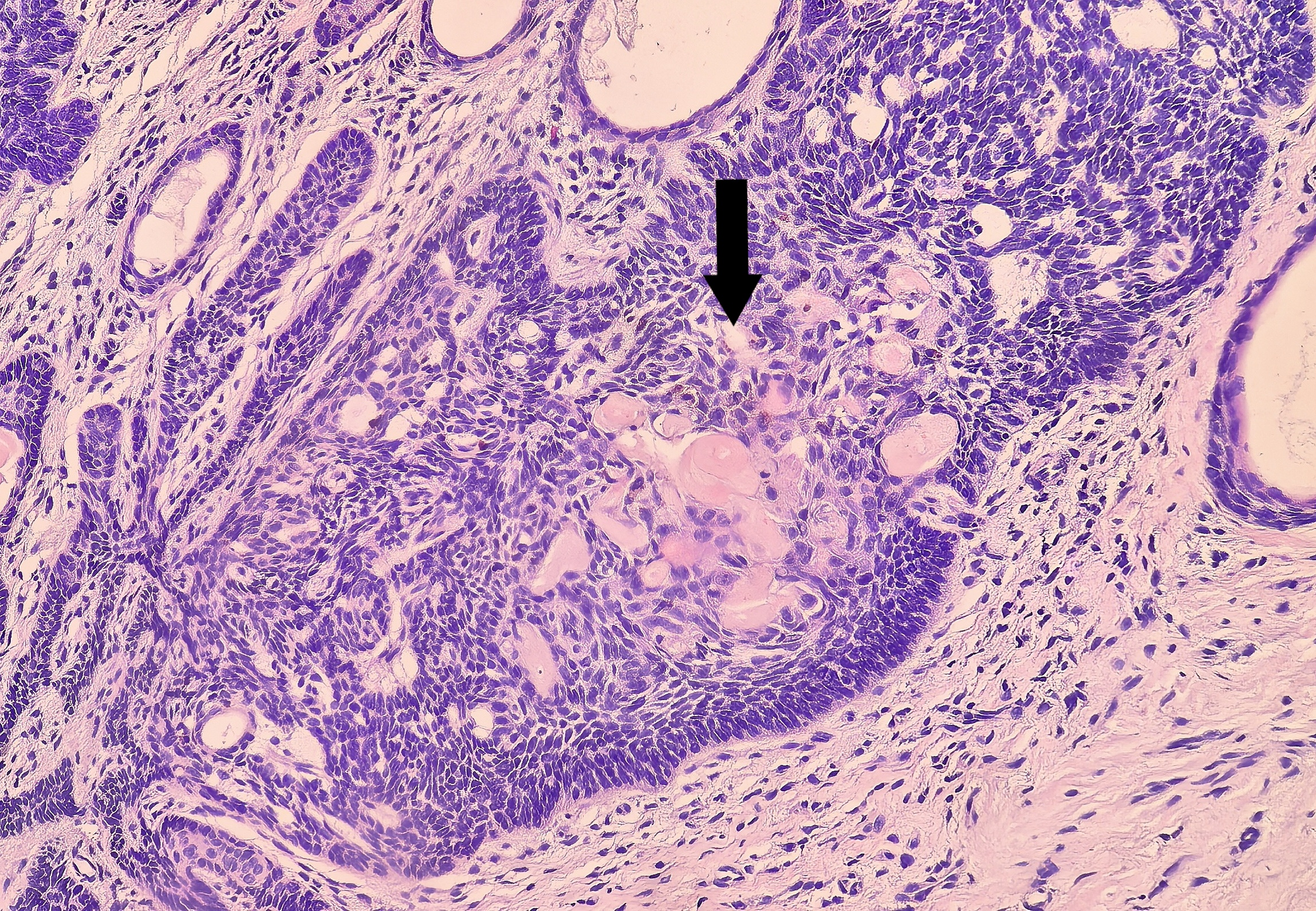 皮肤基底细胞癌伴骨样基质形成一例