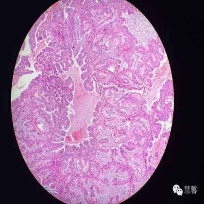 高分化子宫内膜样癌与分泌期子宫内膜、黏液腺癌的鉴别（孔令英分享，刘从容老师讲解）