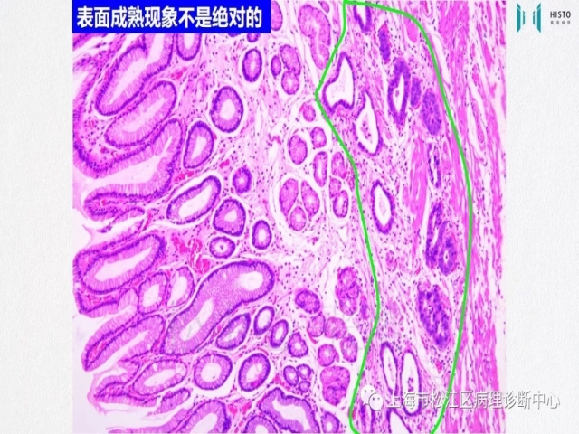 上消化道早癌病理诊断中的困惑及基本对策回顾