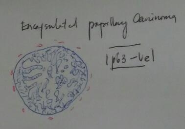 Breast papillary lesions