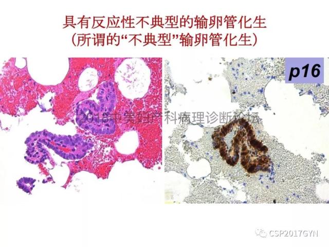 子宫内膜假肿瘤性病变及类似癌样病变