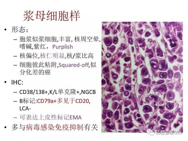 浆细胞相关肿瘤的病理诊断及鉴别诊断