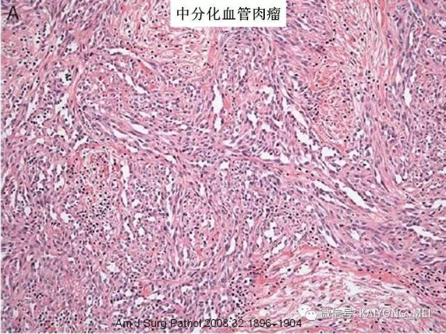 乳腺梭形细胞病变的病理诊断及进展（二）