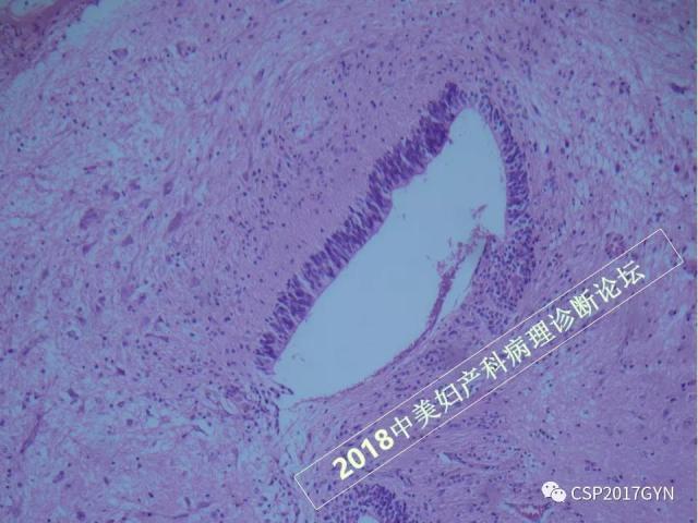 卵巢畸胎瘤诊断难点