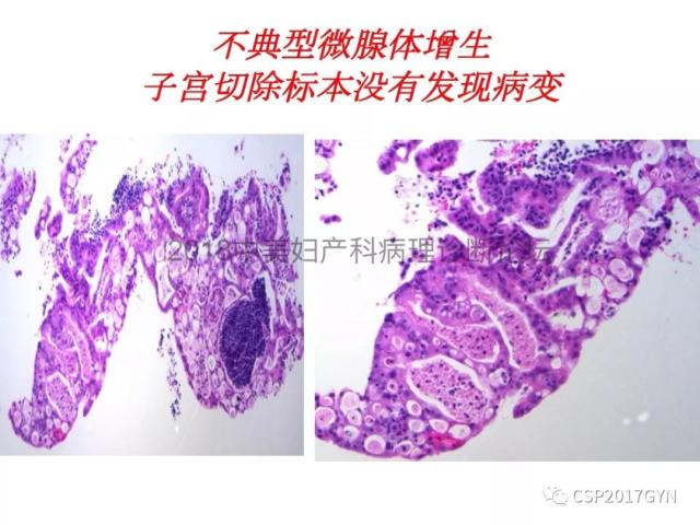 子宫内膜假肿瘤性病变及类似癌样病变