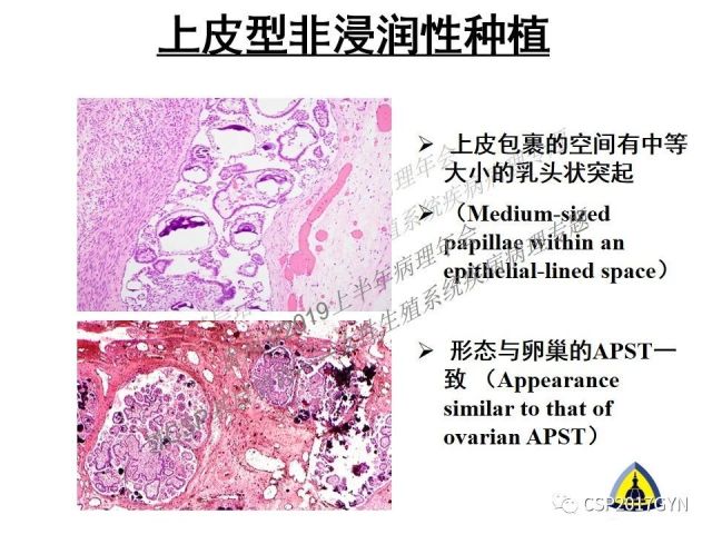 中华病理学会基层培训遵义站讲座（一）——卵巢和输卵管浆液性肿瘤的诊断和鉴别诊断