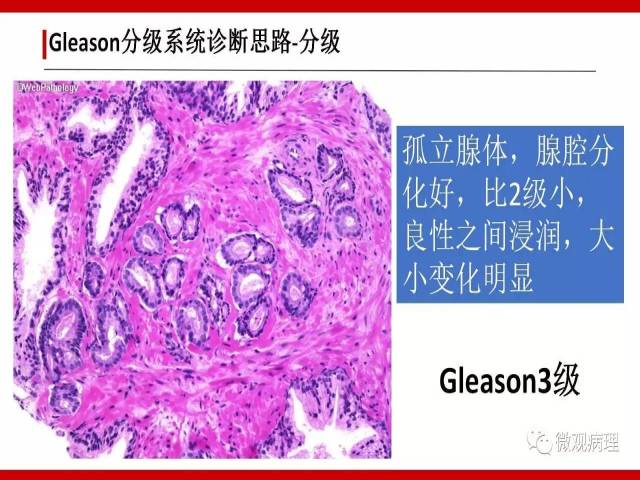前列腺癌Gleason分级系统的前世今生