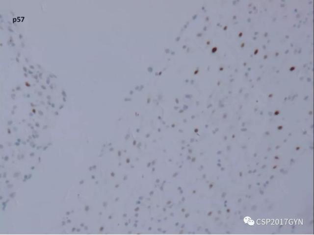 妊娠滋养细胞肿瘤的临床病理学进展