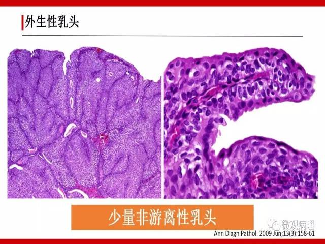 泌尿课程/非浸润性尿路上皮病变诊断的一些困惑