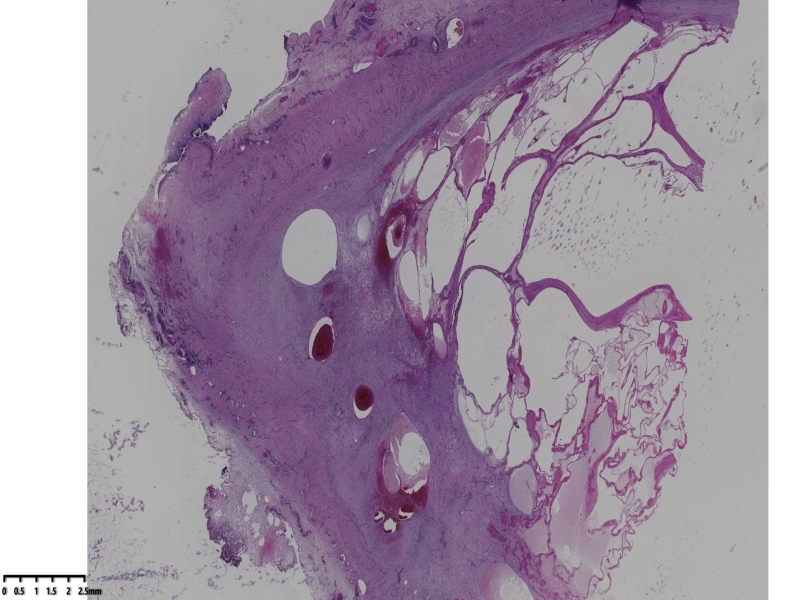 睾丸鞘膜肿物伴鞘膜积液