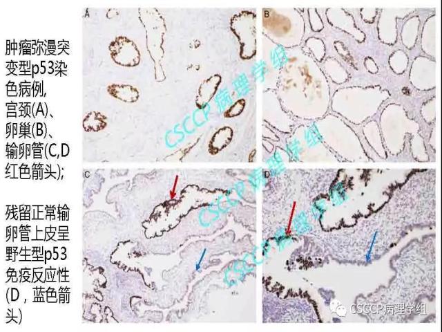 宫颈胃型腺癌中输卵管黏膜受累