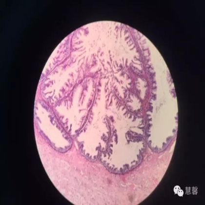交界性黏液性囊腺瘤？癌？（魏娉分享，刘从容老师讲解）