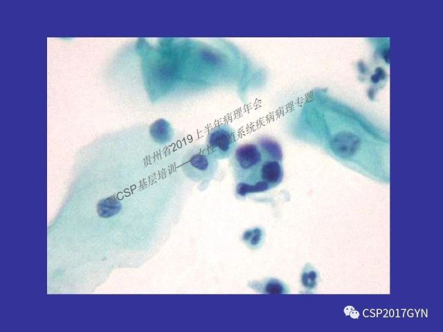 中华病理学会基层培训遵义站讲座（二）——宫颈细胞学诊断中陷阱与筛查进展