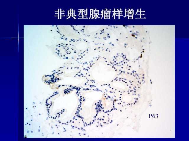 前列腺病理诊断线索（下）——黄教悌