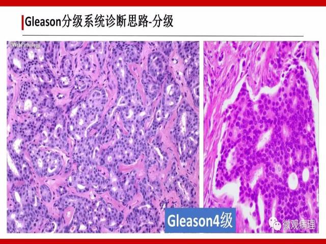 前列腺癌Gleason分级系统的前世今生