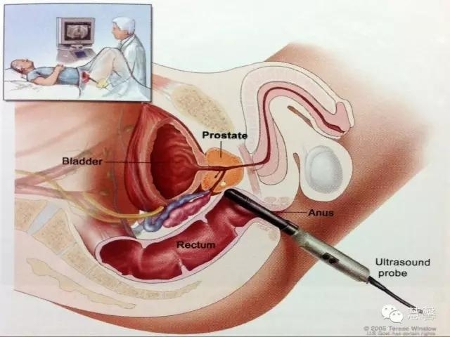 前列腺电切标本出现的非前列腺、非精囊腺组织是什么？原因何在？（张睿病例分享，孔祥田(Max)*Roswell*NM老师讲解）