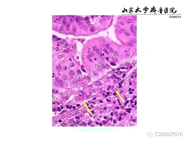 中华病理学会基层培训遵义站讲座（四）——宫颈腺癌的诊断及新分型
