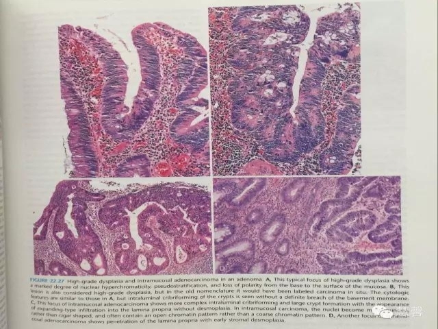 结、直肠管绒毛状腺瘤-高级别病变诊断等相关问题2（悄悄分享、孔祥田(Max)*Roswell*老师讲解）