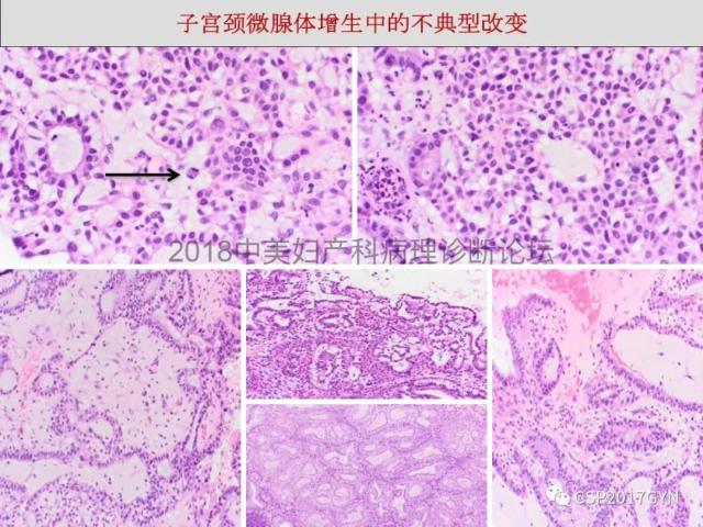子宫内膜假肿瘤性病变及类似癌样病变