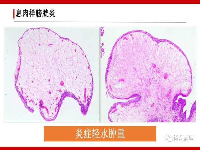 泌尿课程/非浸润性尿路上皮病变诊断的一些困惑