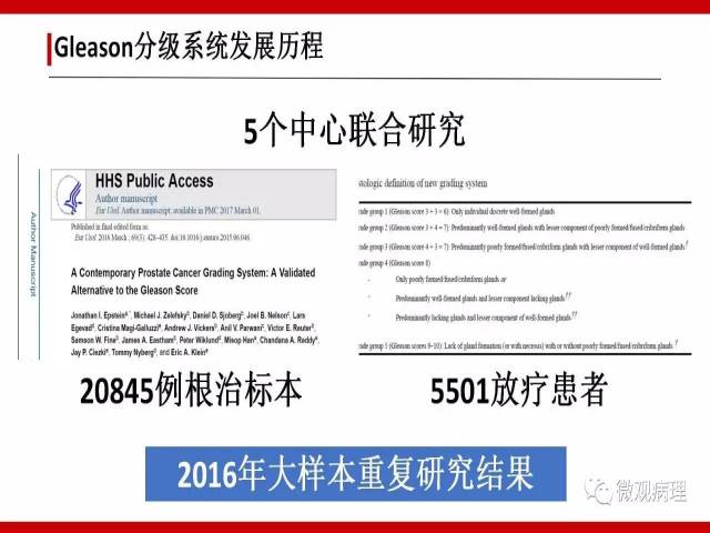 前列腺癌Gleason分级系统的前世今生