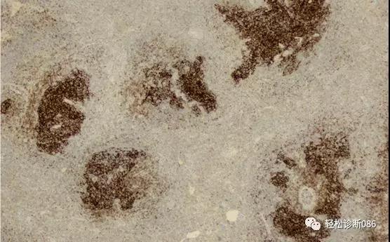 滤泡辅助T细胞（TFH）及其相关淋巴瘤（6）