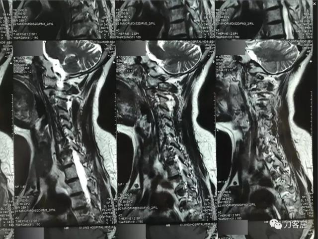 医生及患者通用:如何用手机翻拍X线片,磁共振片子,CT片子进行网络求医、病例讨论及保留资料 医生及患者通用:如何用手机翻拍X线片,磁共振片子,CT片子进行网络求医、病例讨论及保留资料