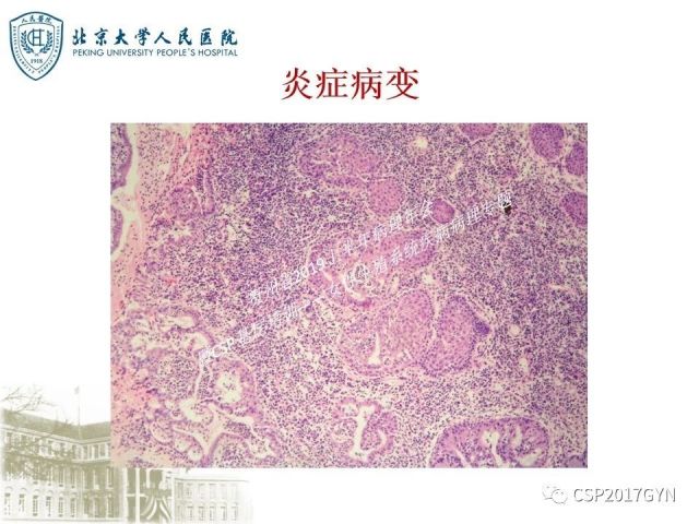中华病理学会基层培训遵义站讲座（三）——宫颈鳞状上皮病变的病理诊断与鉴别诊断