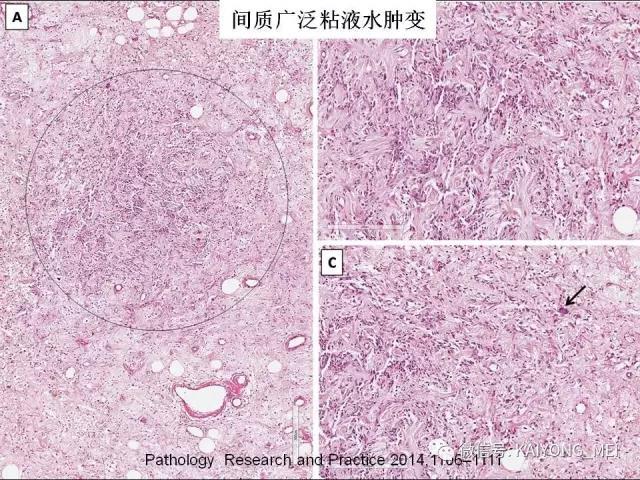 乳腺梭形细胞病变的病理诊断及进展（一）
