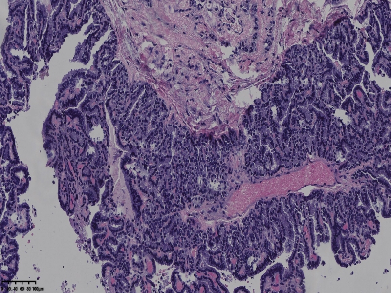 这个甲状腺肿瘤怎么看？