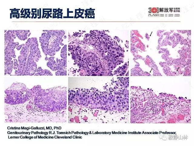 泌尿系统常见肿瘤标本病理报告规范