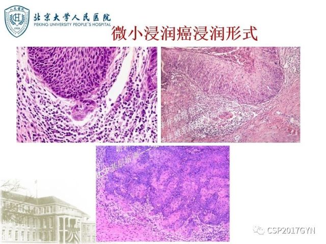 中华病理学会基层培训遵义站讲座（三）——宫颈鳞状上皮病变的病理诊断与鉴别诊断