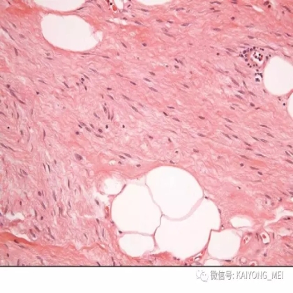 女性生殖道软组织肿瘤病理诊断及进展（二）