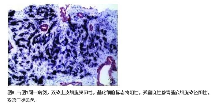 前列腺疾病的免疫组化诊断