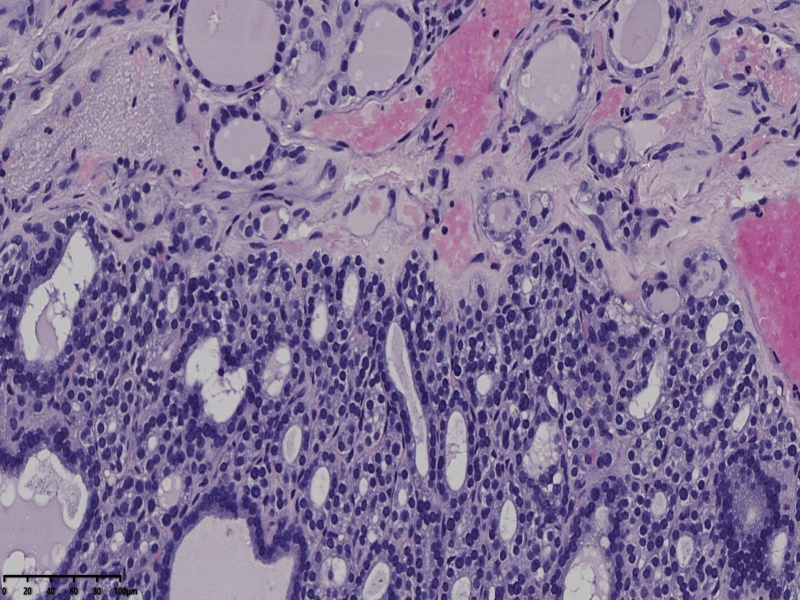 这个甲状腺肿瘤怎么看？