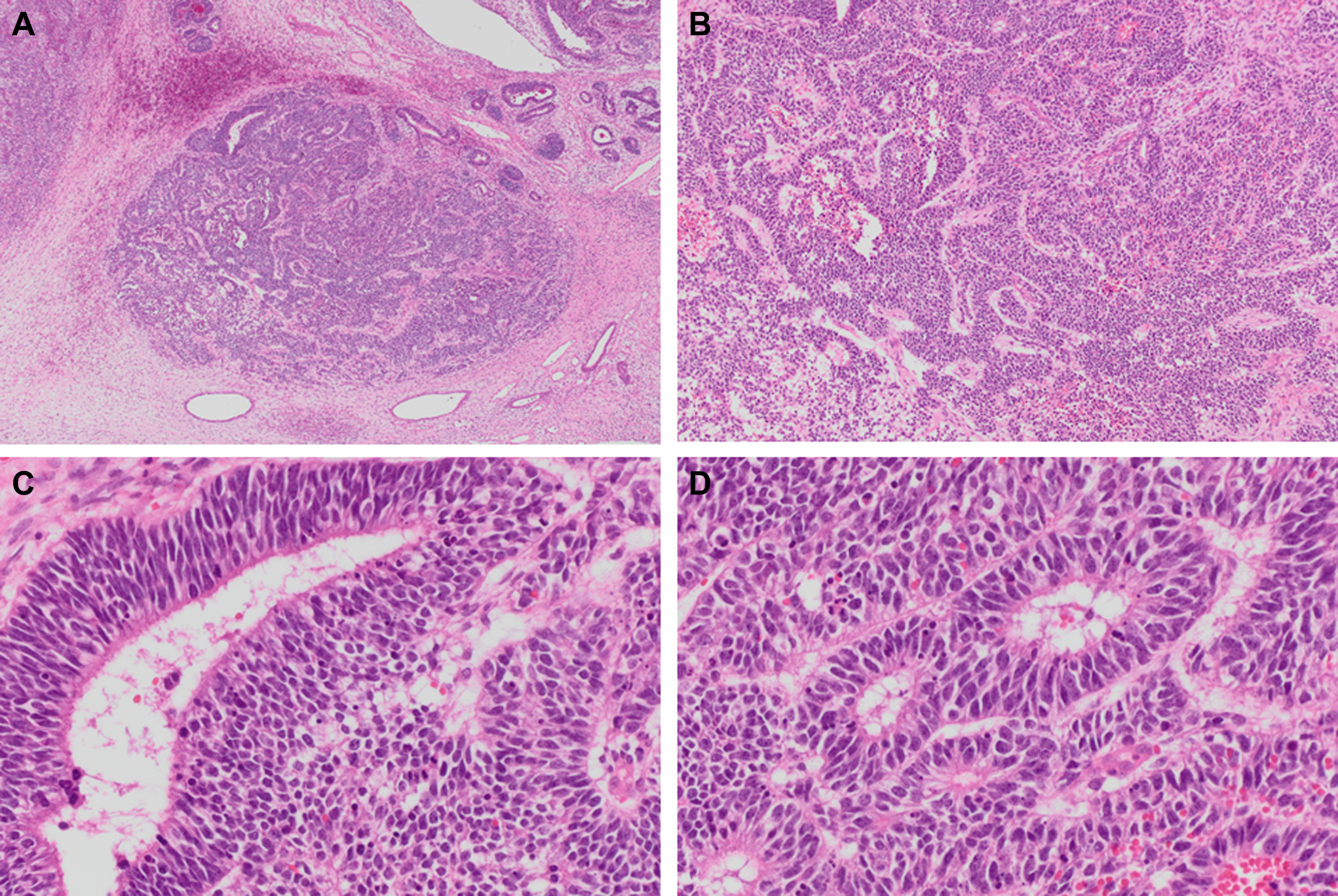 文献速递-DICER1相关的Wilms样肿瘤