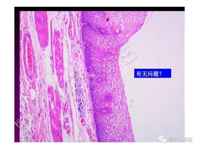 上消化道早癌病理的学习心得体会（附胃牵手癌的病例特点文献学习）