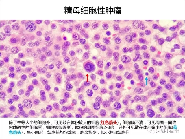 泌尿病理--精原细胞瘤VS精母细胞瘤