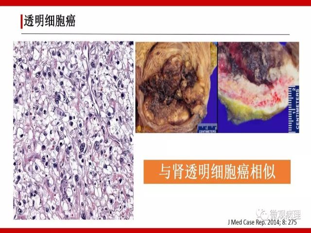 泌尿课程/尿路腺样病变的诊断要点