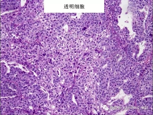卵巢癌的病理诊断新进展（一）