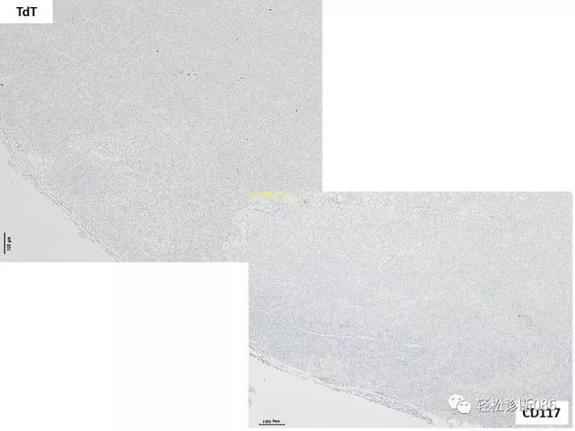 淋巴母细胞淋巴瘤