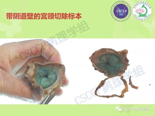 宫颈与子宫病变病理标本取材