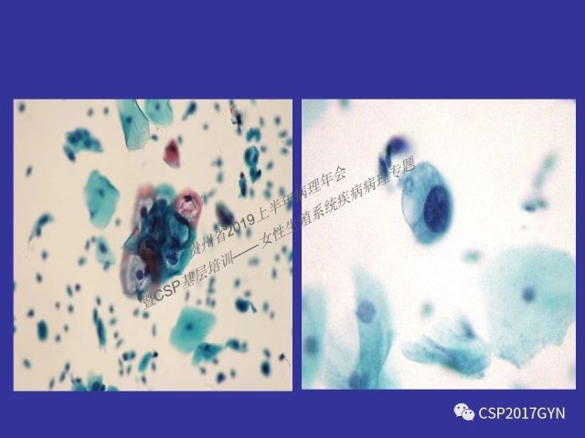 中华病理学会基层培训遵义站讲座（二）——宫颈细胞学诊断中陷阱与筛查进展