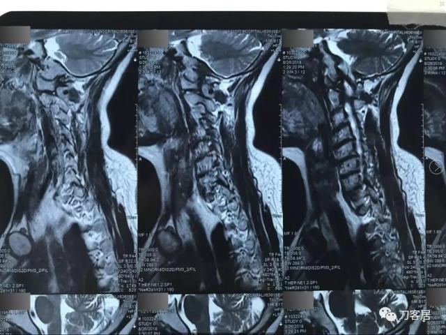 医生及患者通用:如何用手机翻拍X线片,磁共振片子,CT片子进行网络求医、病例讨论及保留资料 医生及患者通用:如何用手机翻拍X线片,磁共振片子,CT片子进行网络求医、病例讨论及保留资料