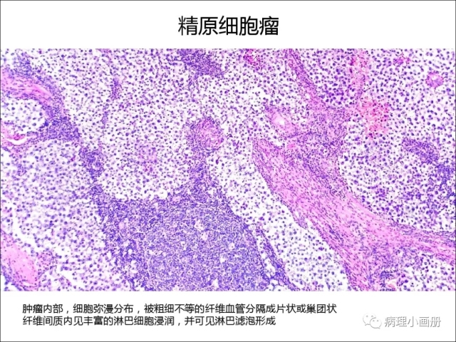 泌尿病理--精原细胞瘤VS精母细胞瘤