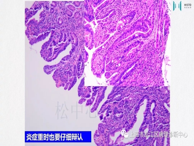 上消化道早癌病理诊断中的困惑及基本对策回顾