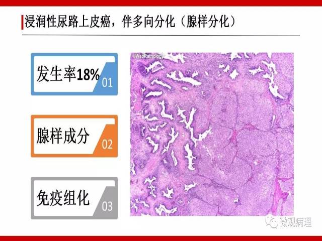 泌尿课程/浸润性尿路上皮癌病理学类型